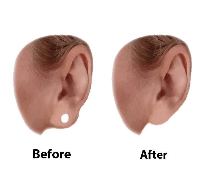 graphic of gauge earlobe repair