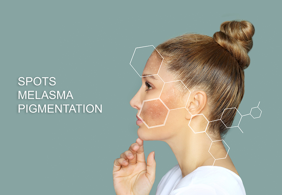picture of woman with melasma