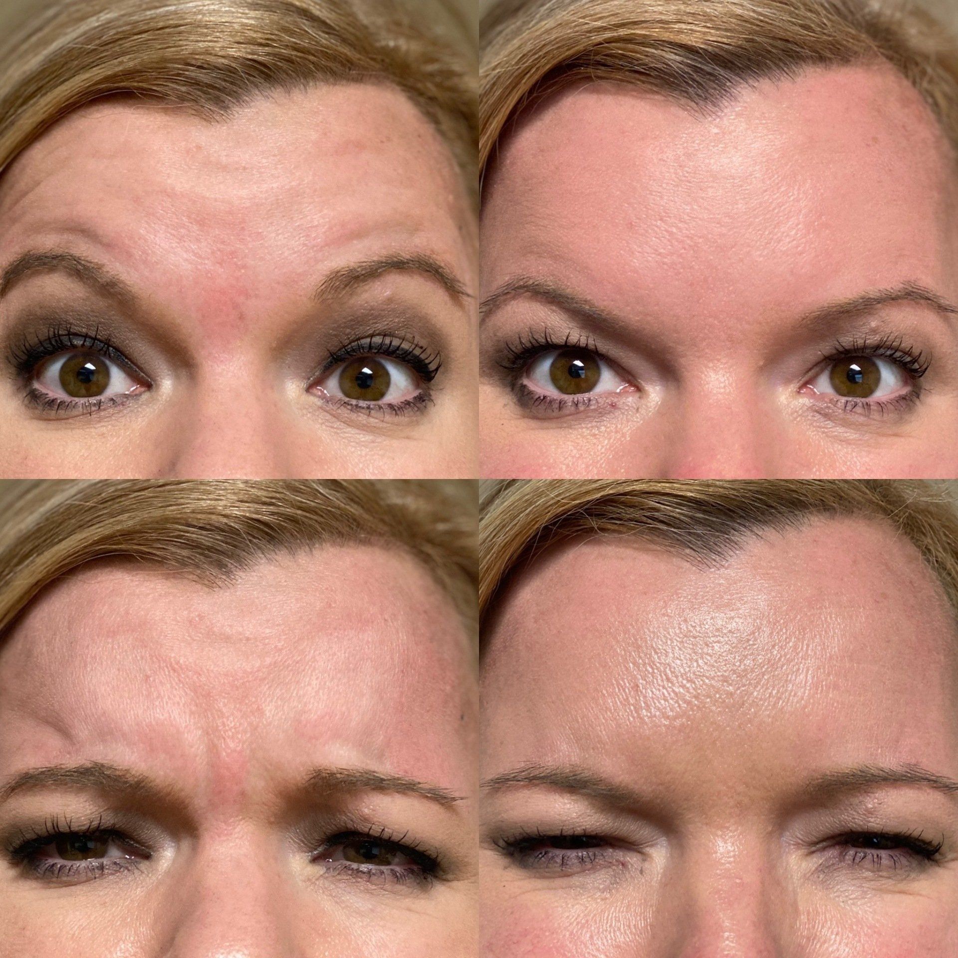 before and after dysport