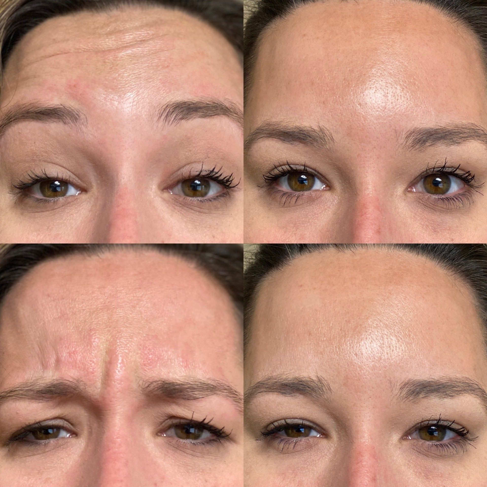 before and after botox