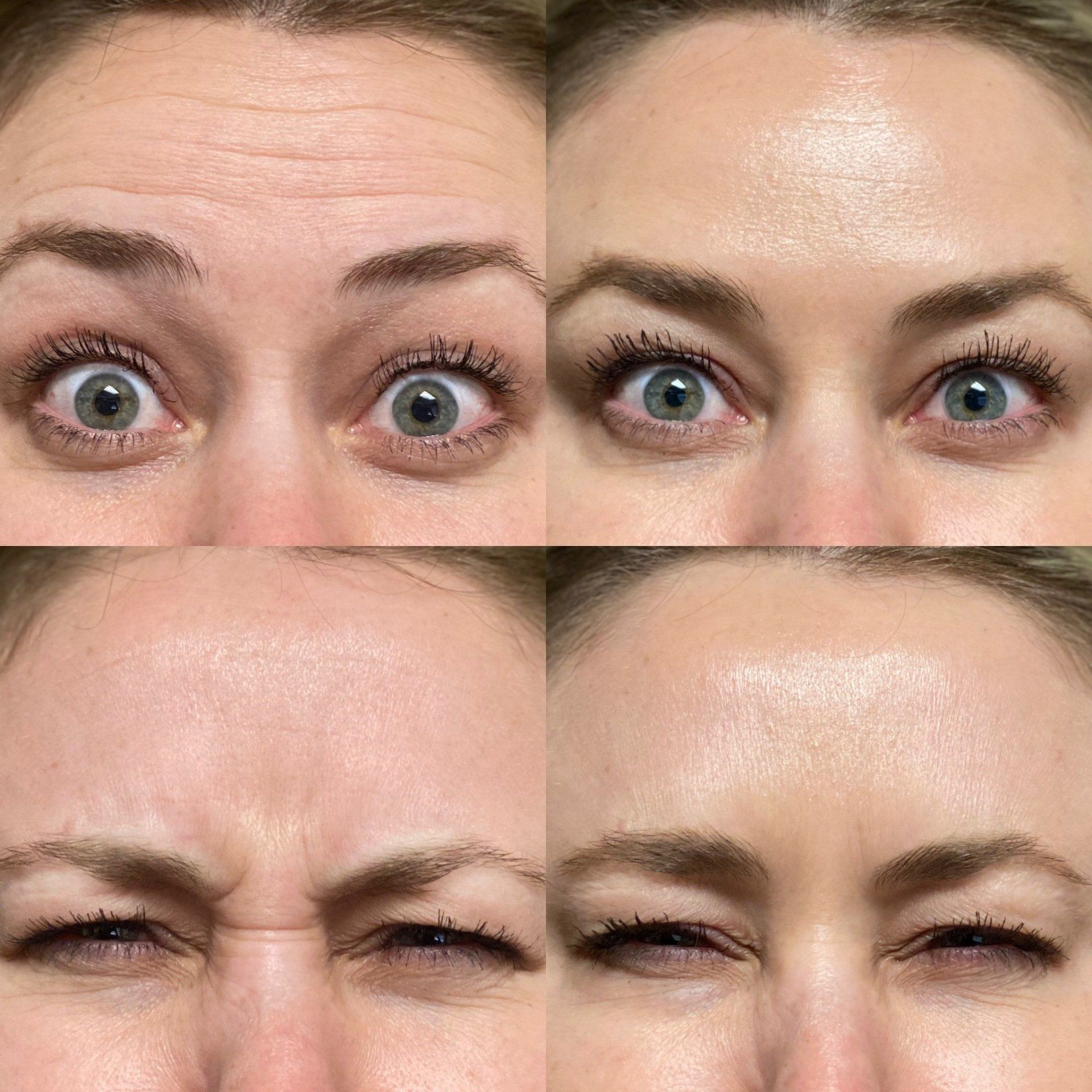 before and after dysport