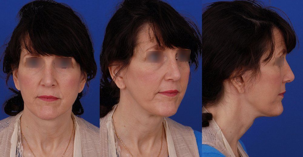 female patient after multiple facial plastic surgery procedures