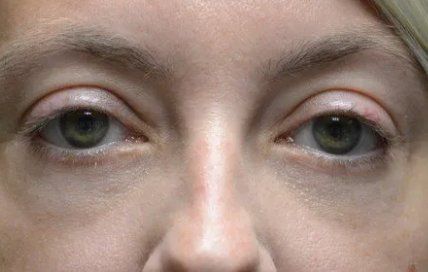 young woman after undereye blepharoplasty