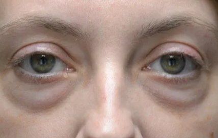 young woman with severe undereye bags