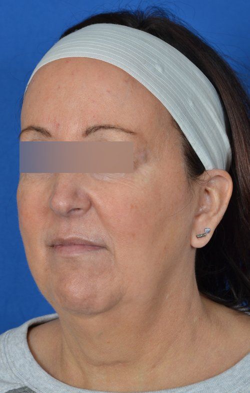 mini facelift before and after