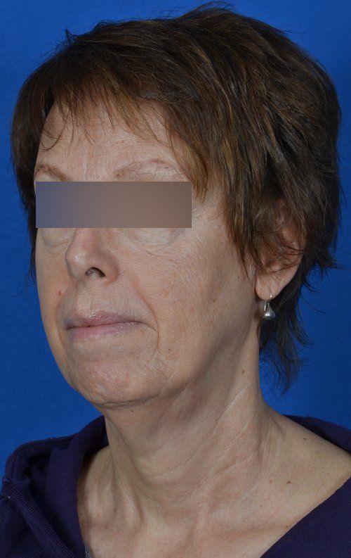 mini facelift before and after