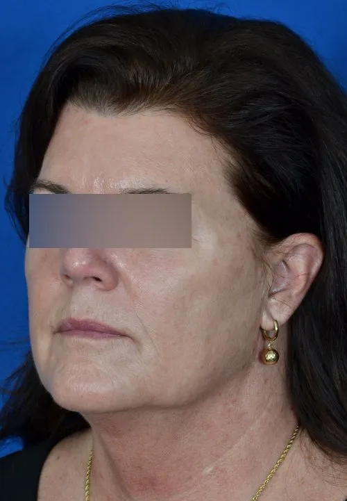 mini facelift before and after