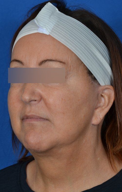 mini facelift before and after