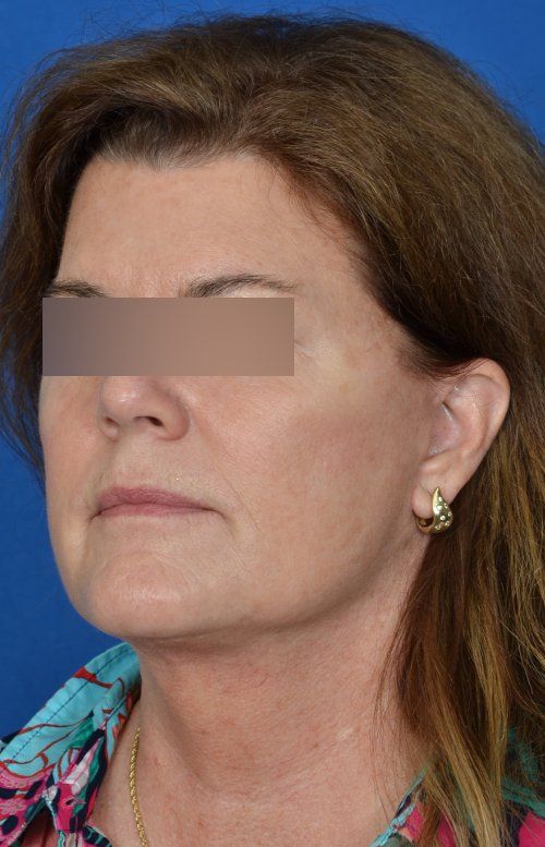 mini facelift before and after