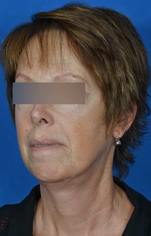 mini facelift before and after