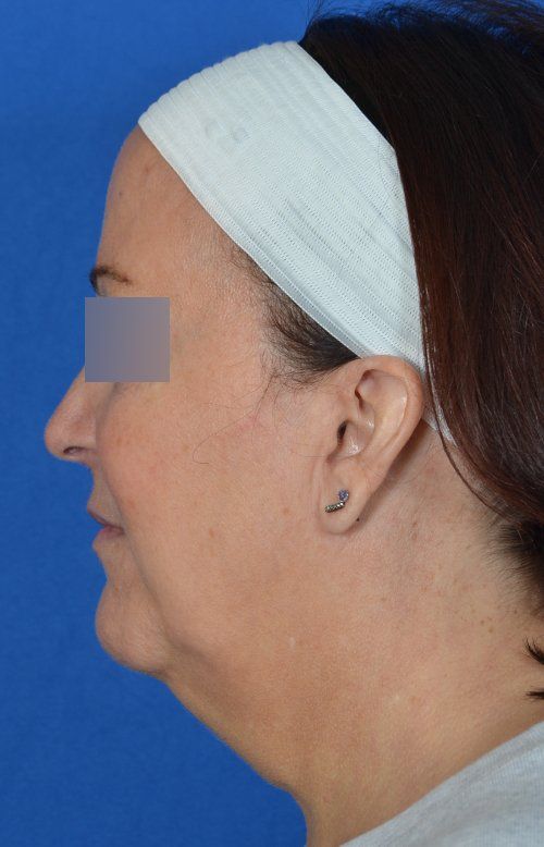 mini facelift before and after
