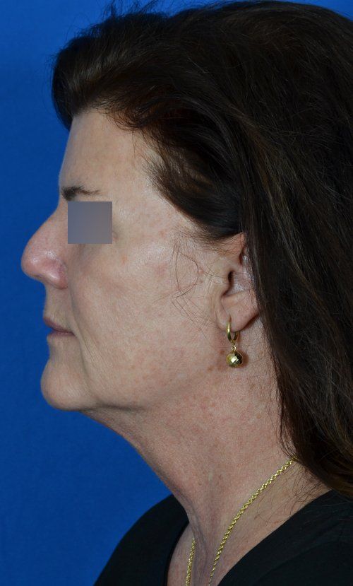 mini facelift before and after