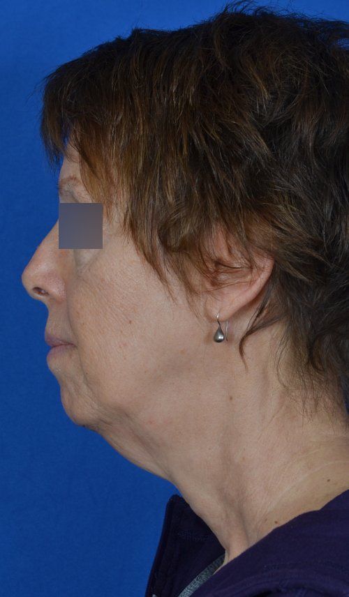 mini facelift before and after