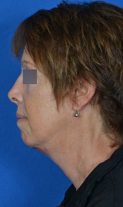 mini facelift before and after