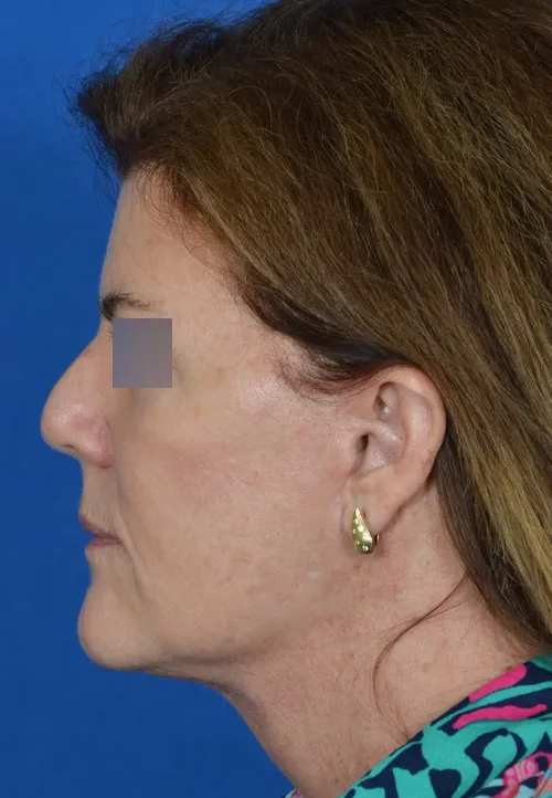 mini facelift before and after
