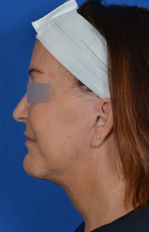 mini facelift before and after