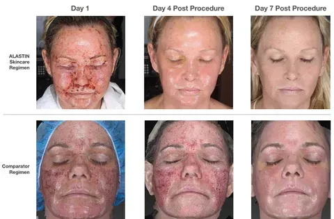 alastin skincare regimen before and after