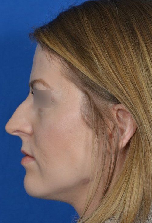 rhinoplasty side view