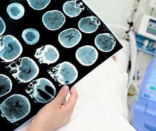 Una persona sostiene una tomografía computarizada de su cabeza.