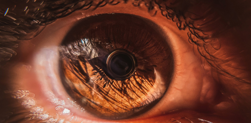 A close-up view of an eye showing signs of glaucoma