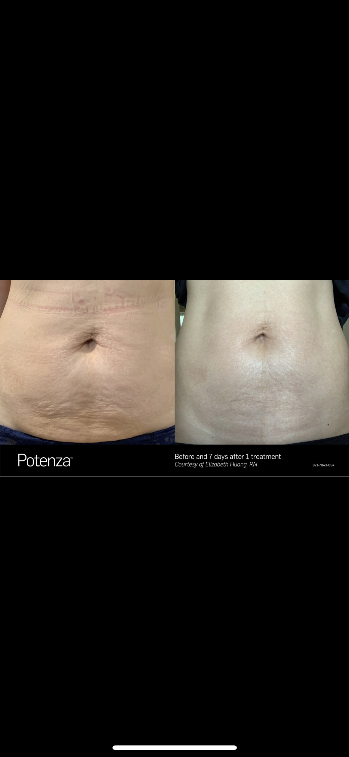 A before and after picture of a woman 's stomach.