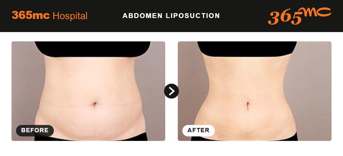 Abdomen liposuction before and after 1