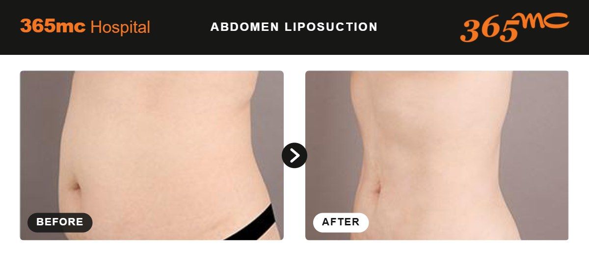 Abdomen liposuction before and after 2