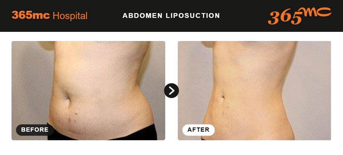 Abdomen liposuction before and after 3