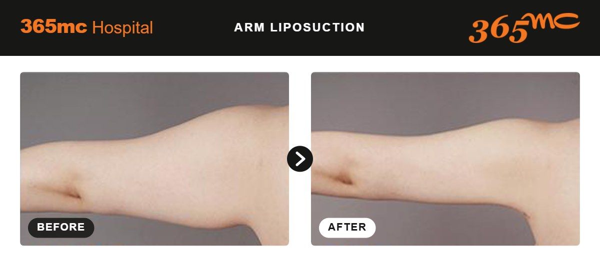 Arm liposuction before and after 1