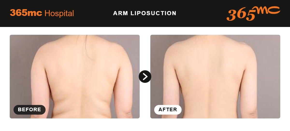 Arm liposuction before and after 2