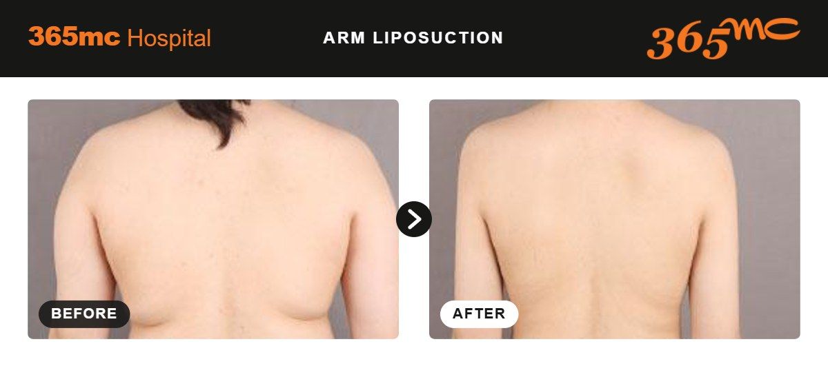 Arm liposuction before and after 3