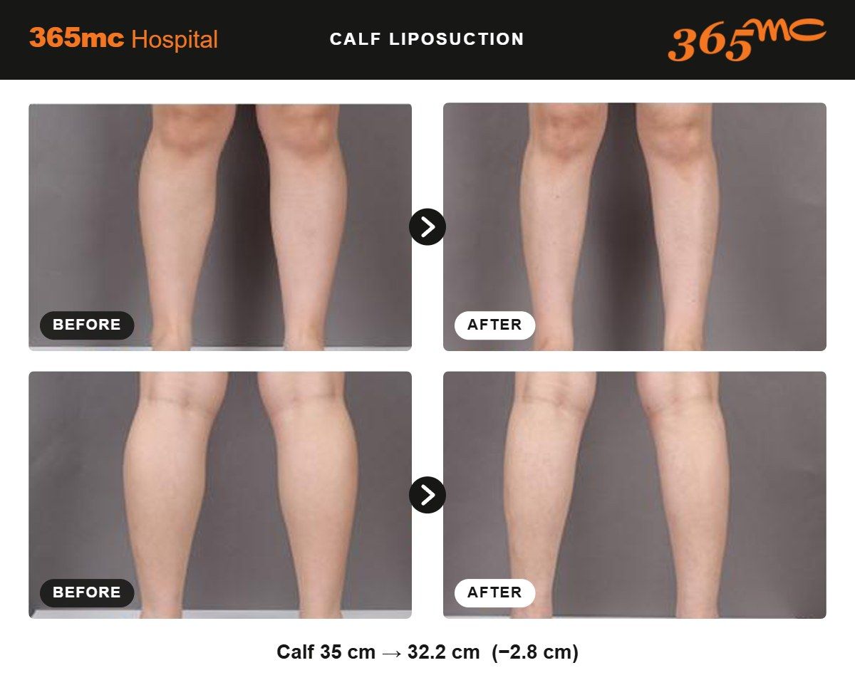 Calf liposuction before and after 1