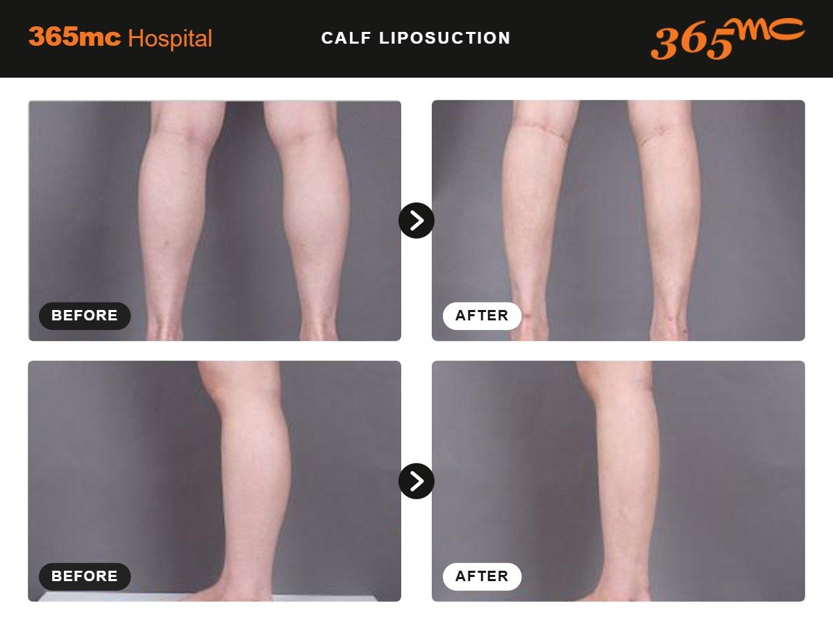 Calf liposuction before and after 2