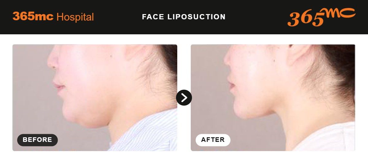 Face liposuction before and after 1
