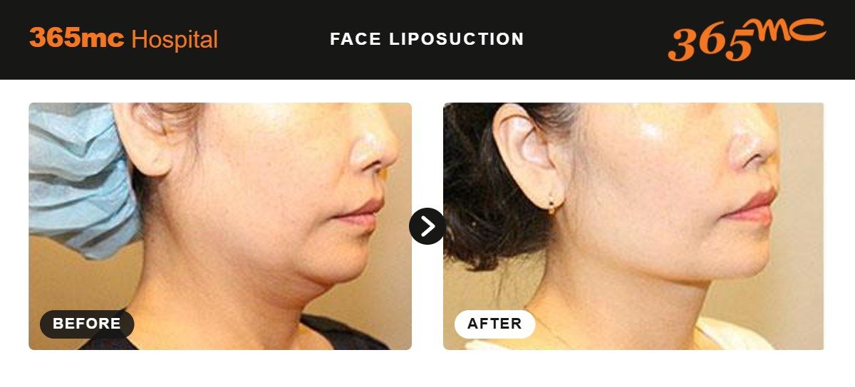 Face liposuction before and after 2