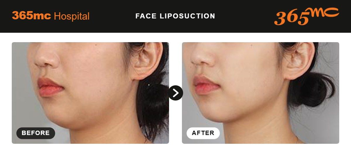 Face liposuction before and after 3