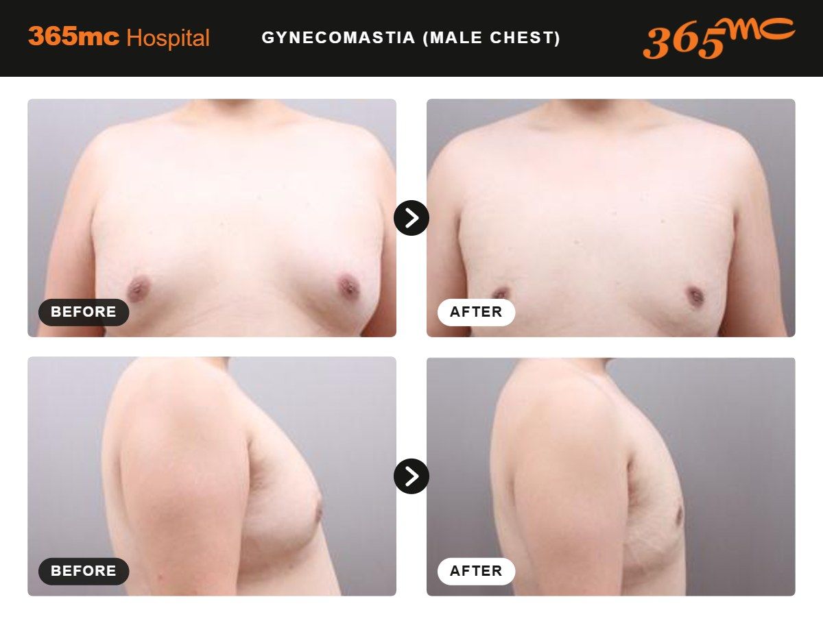 Male Chest liposuction before and after 1
