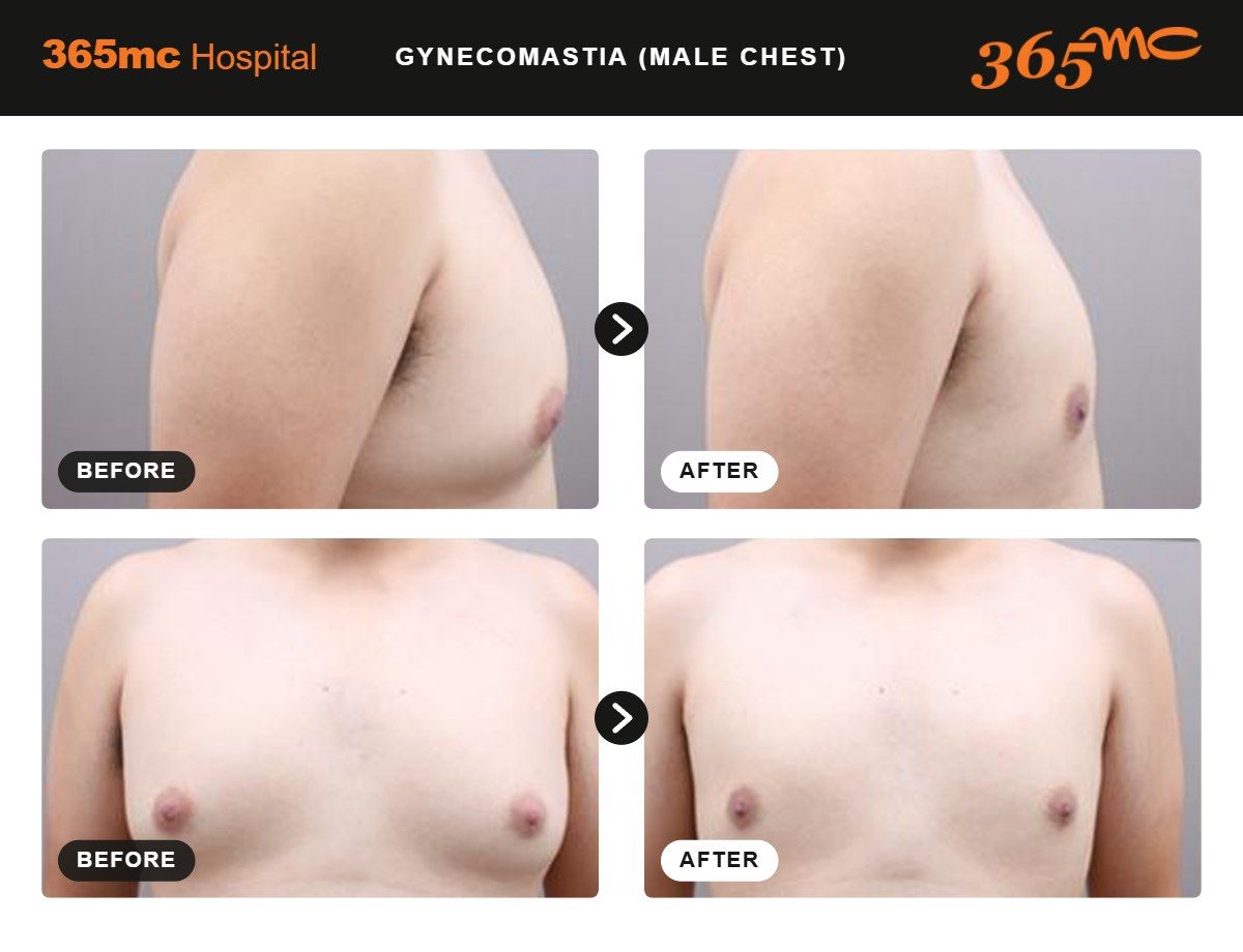 Male Chest liposuction before and after 2