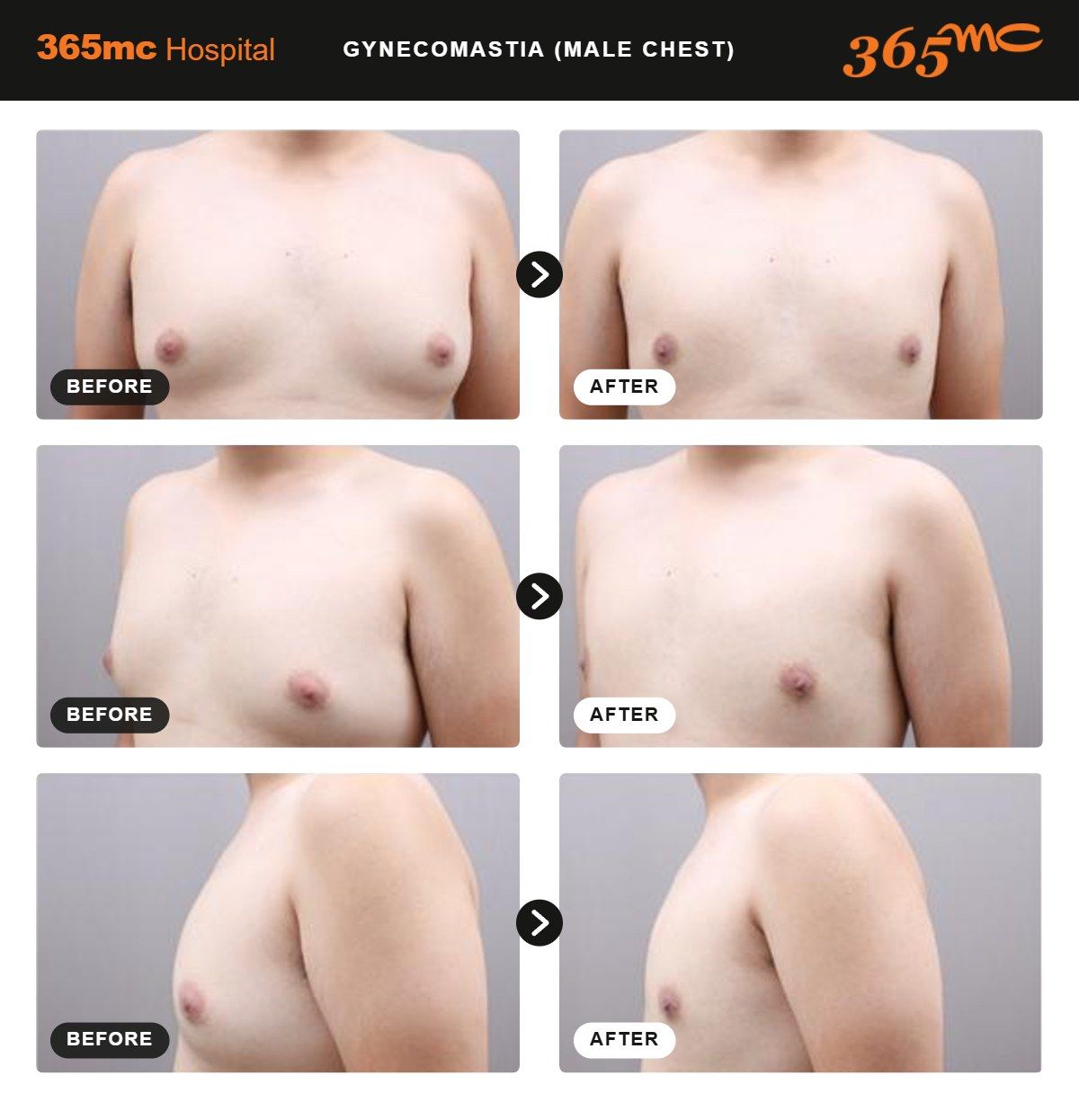 Male Chest liposuction before and after 3