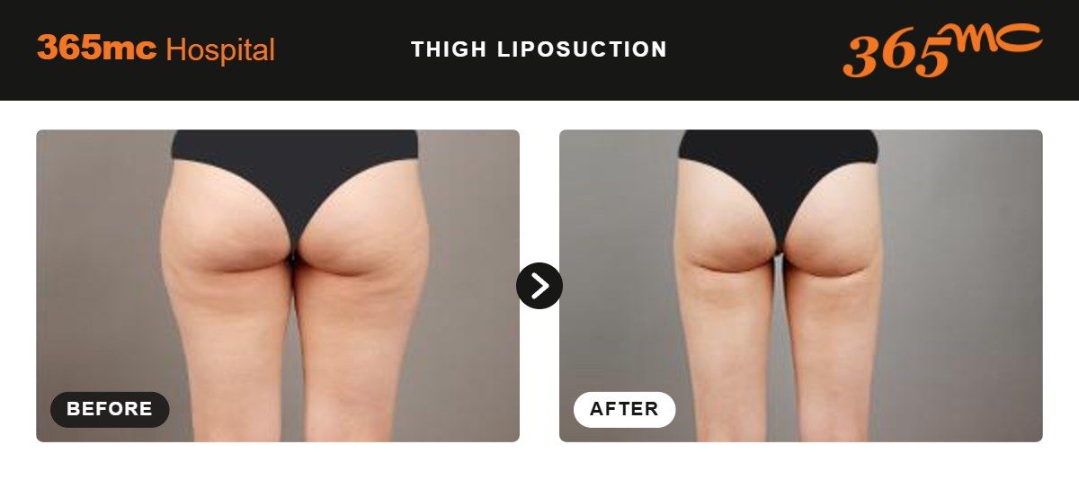 Thigh liposuction before and after 1