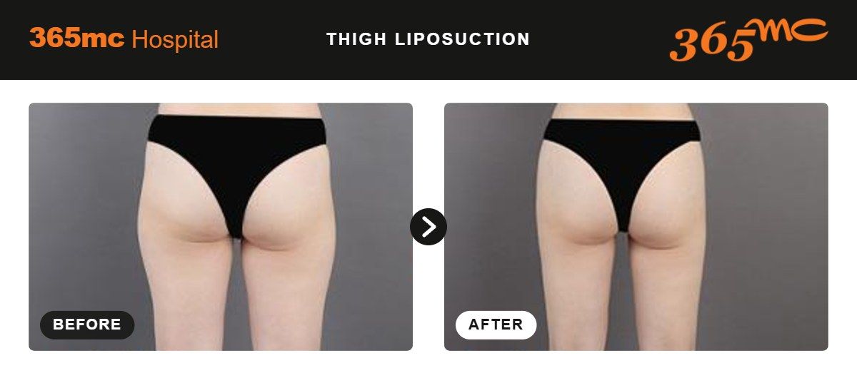 Thigh liposuction before and after 2