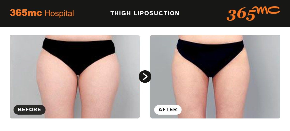 Thigh liposuction before and after 3