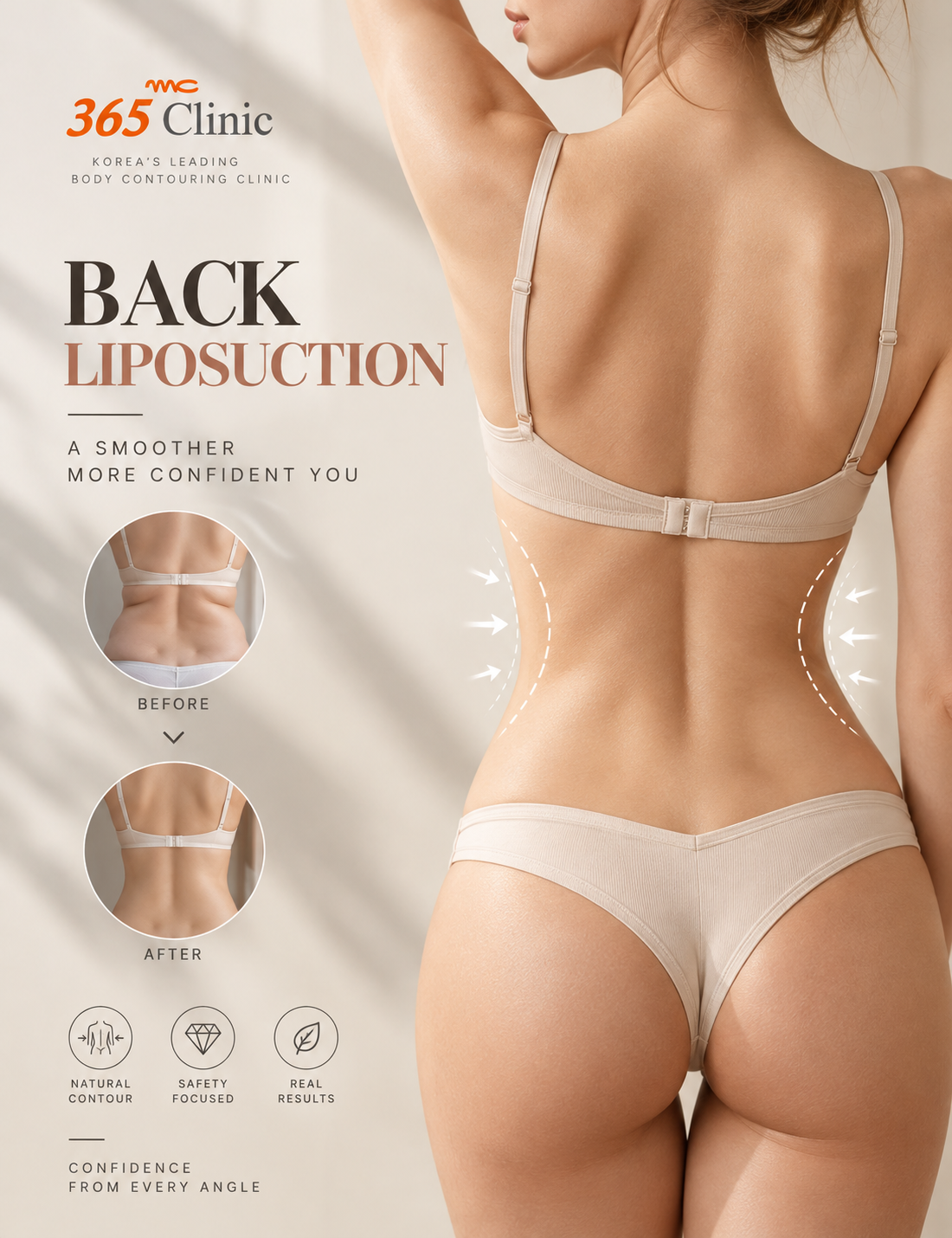 Back liposuction at 365mc Seoul
