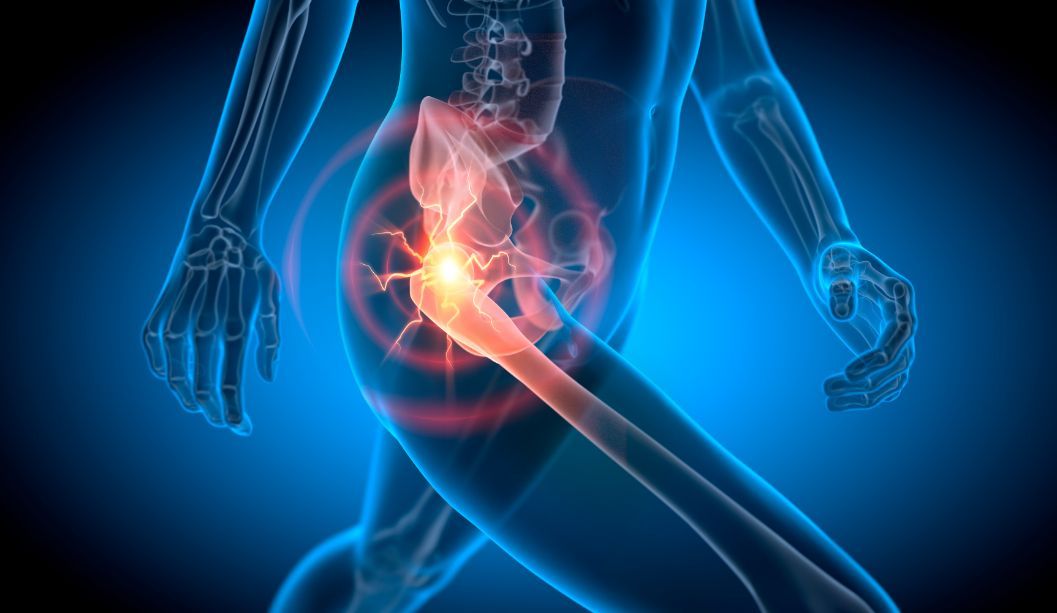 Hip Replacement