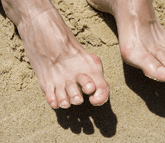 hammer toe