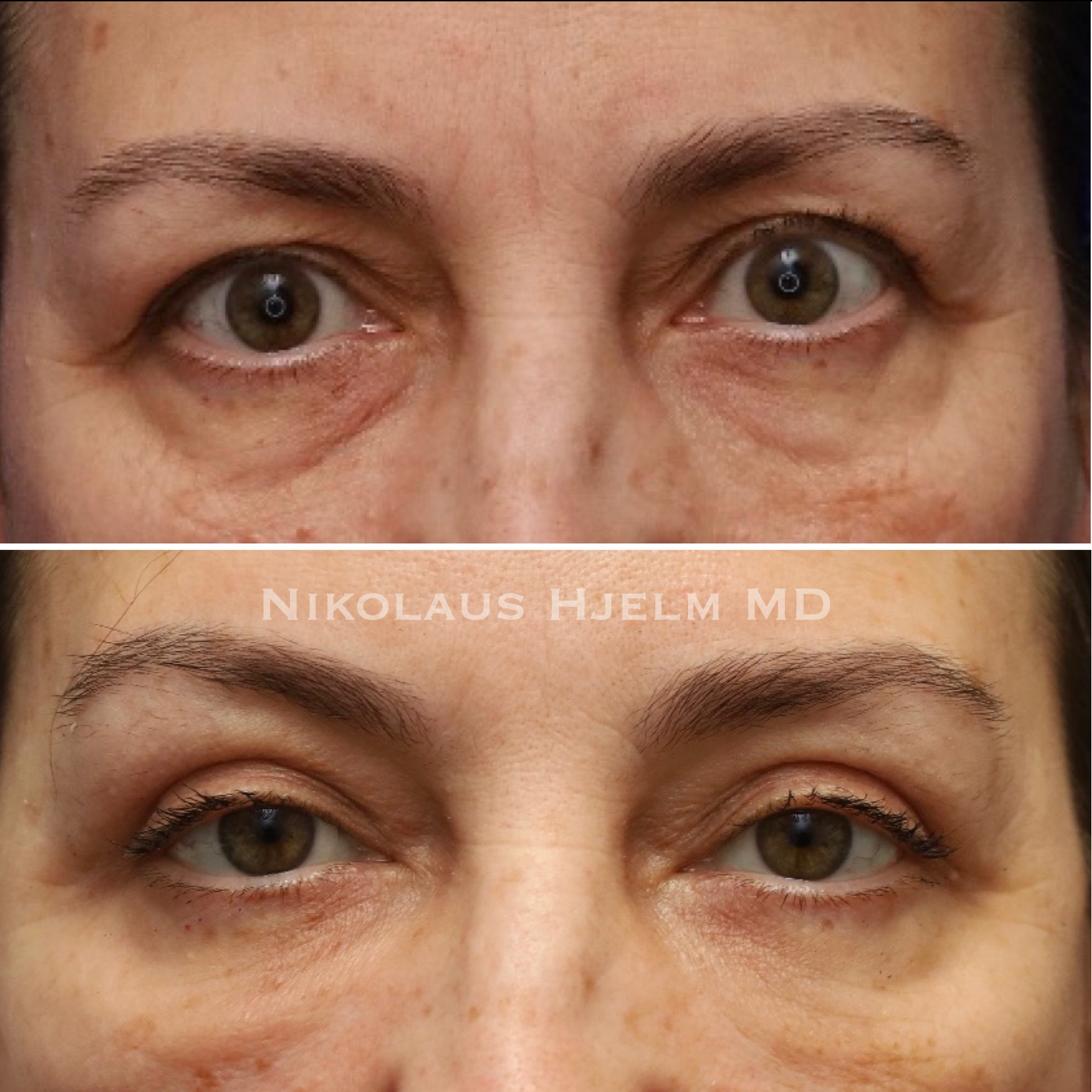 Upper Blepharoplasty