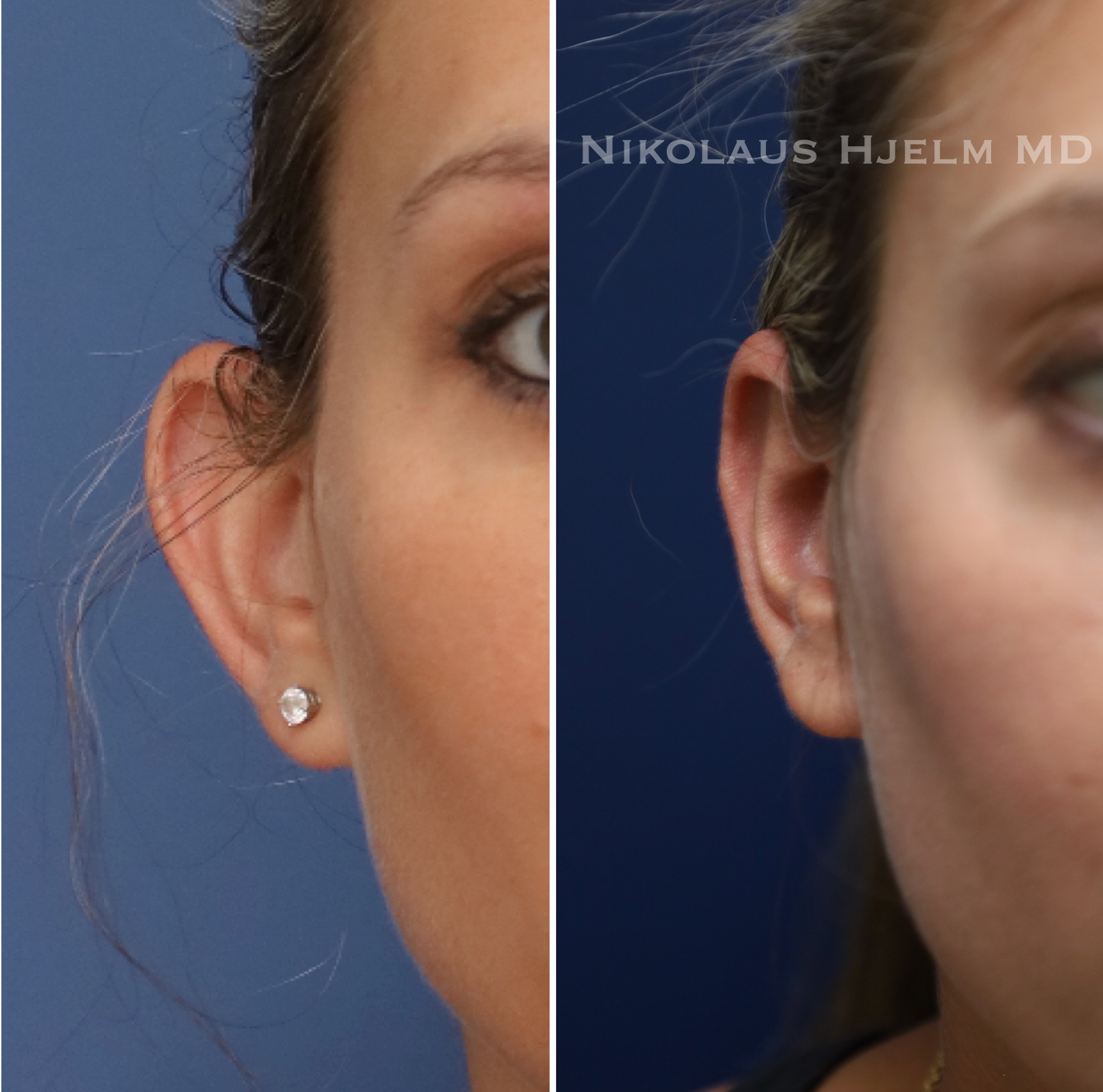 Otoplasty