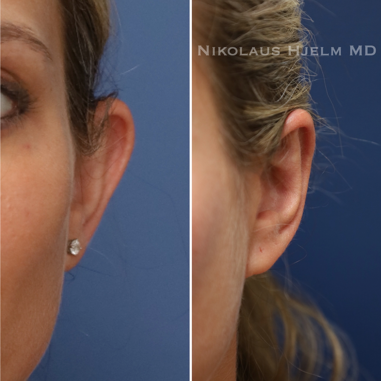 Otoplasty