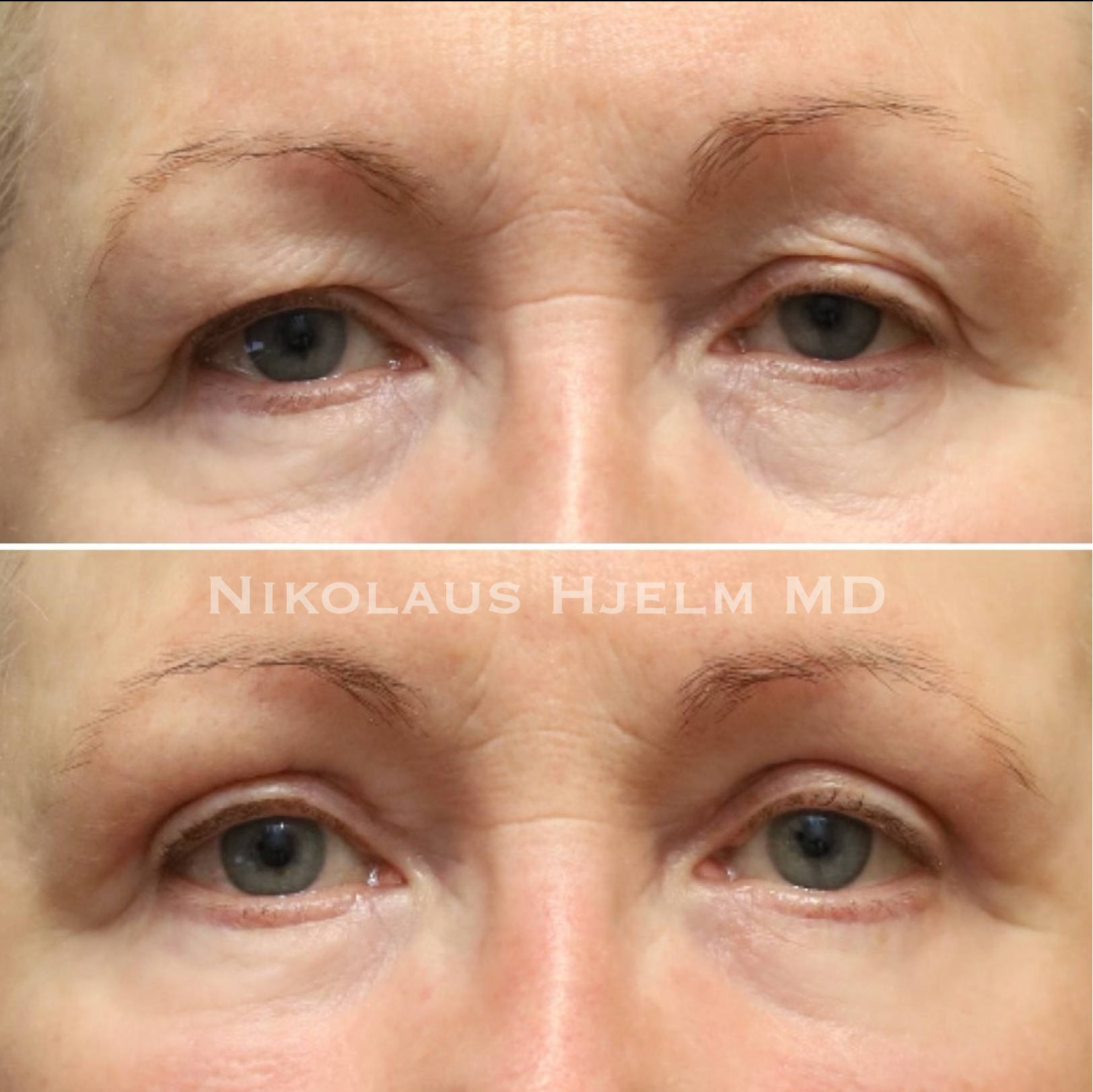 Upper Blepharoplasty