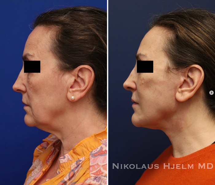 Facelift